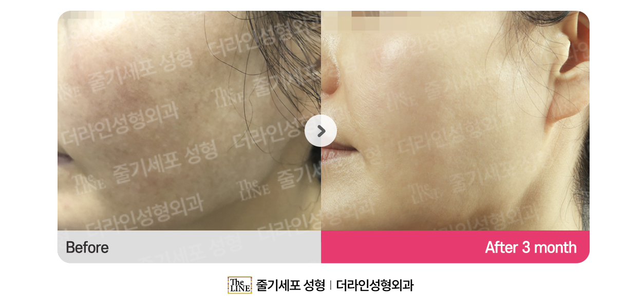 SVF 피부 & 리프팅 (통합) 대표 이미지