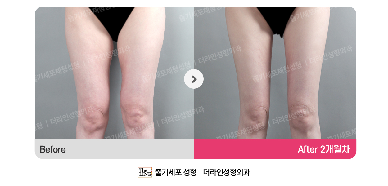 더라인성형외과 시술 상세 이미지