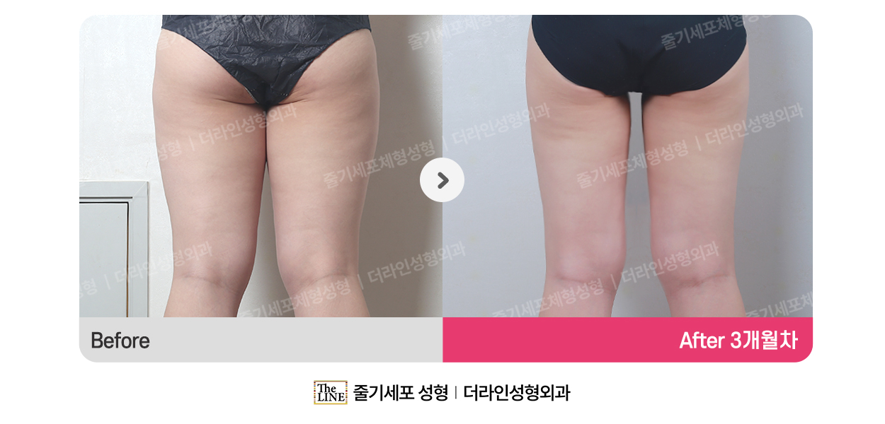 더라인성형외과 시술 상세 이미지