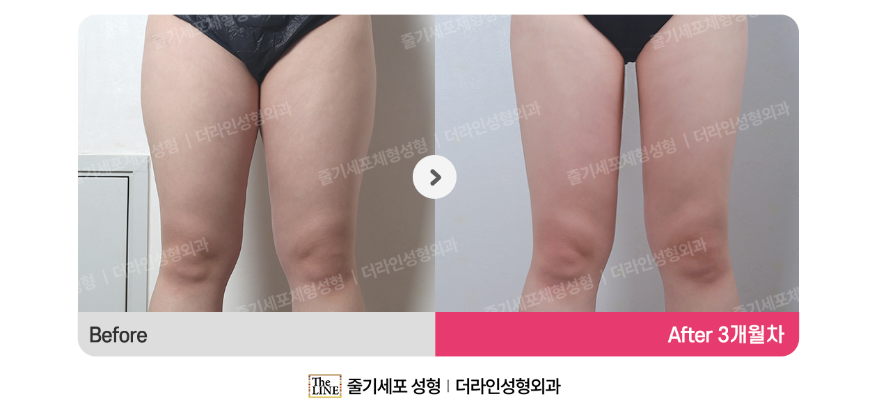 더라인성형외과 시술 상세 이미지