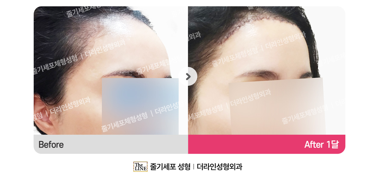 더라인성형외과 시술 상세 이미지