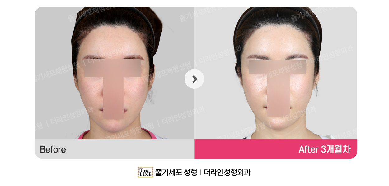 더라인성형외과 시술 상세 이미지