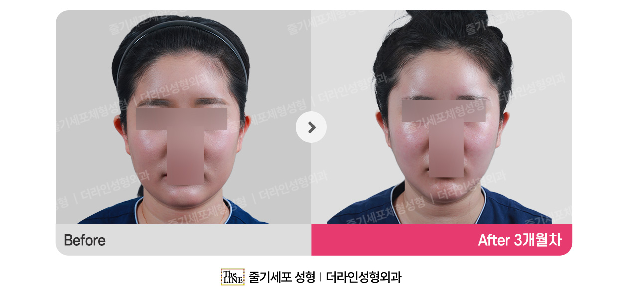 더라인성형외과 시술 상세 이미지