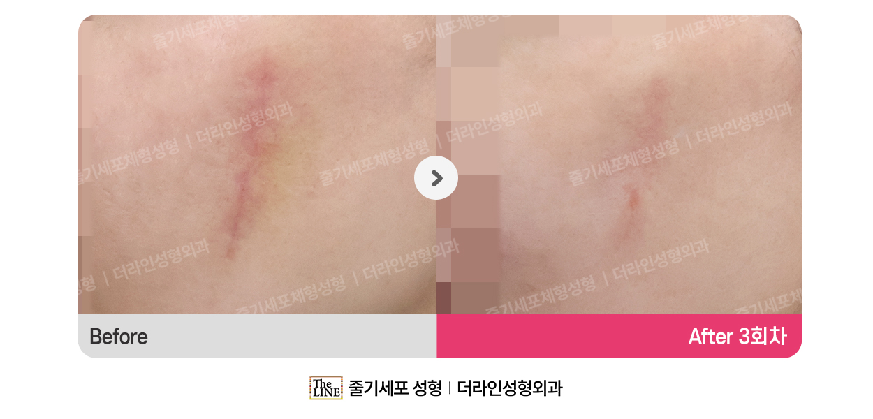 SVF 치료 (통합) 대표 이미지