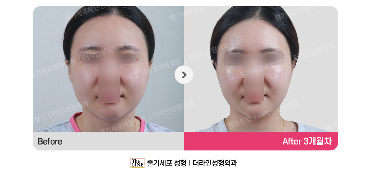 더라인성형외과 시술 상세 이미지