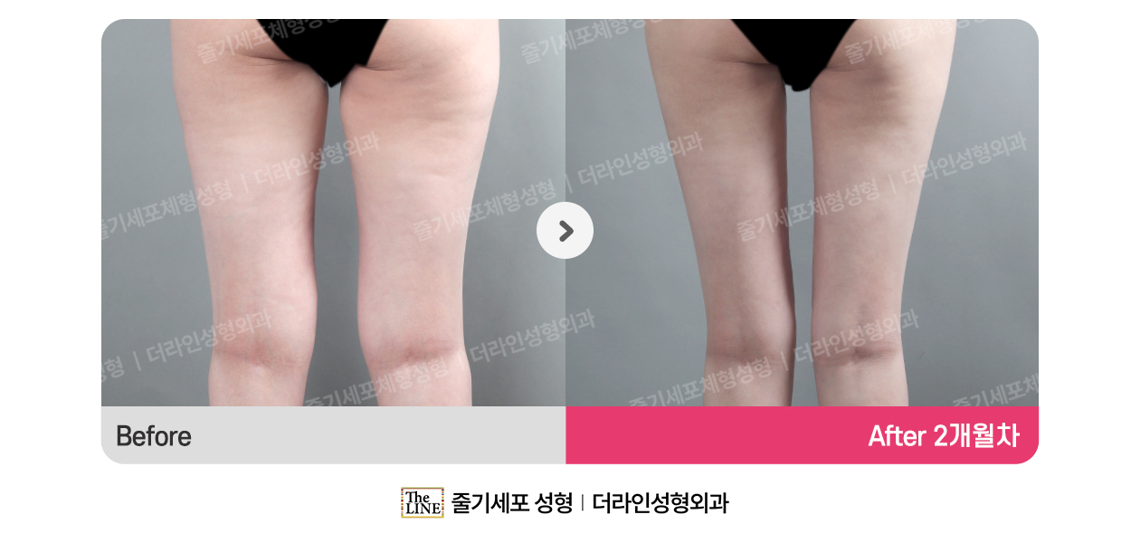 더라인성형외과 시술 상세 이미지