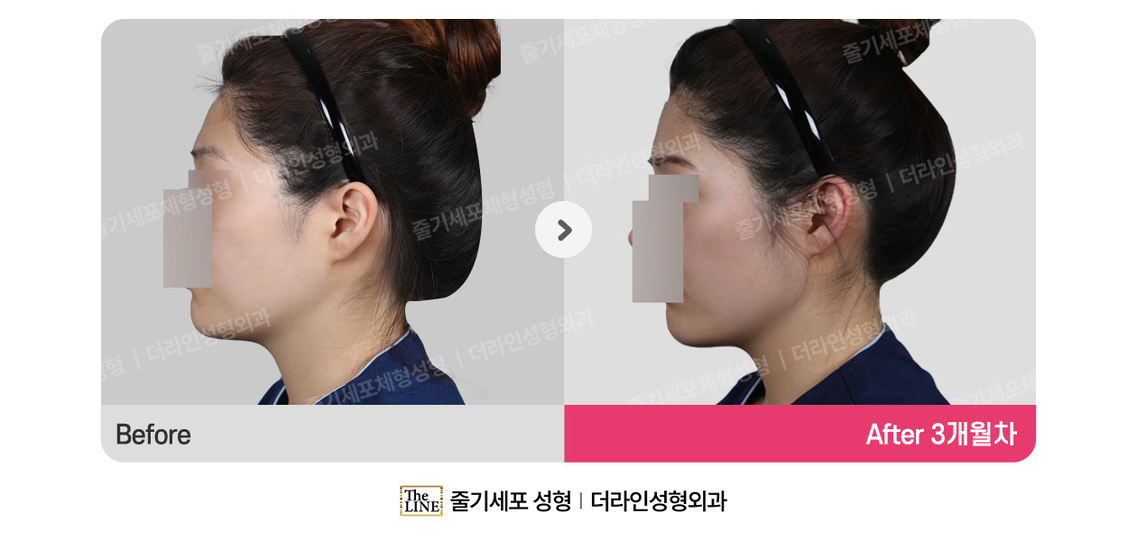 더라인성형외과 시술 상세 이미지