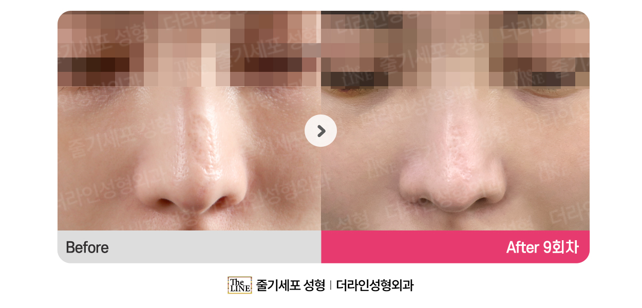 더라인성형외과 시술 상세 이미지