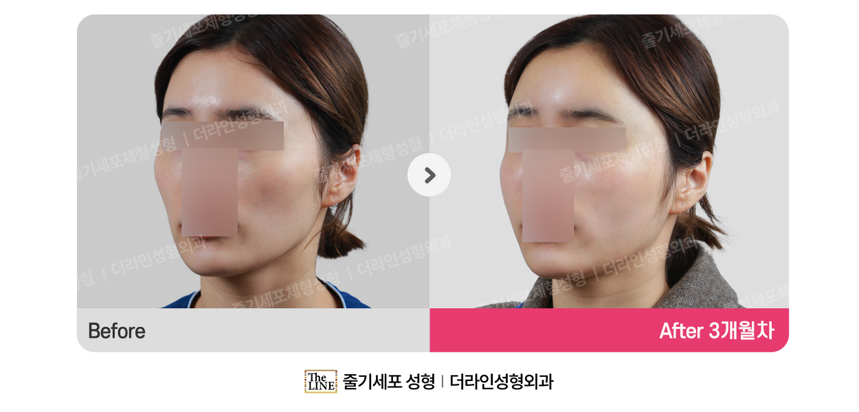 더라인성형외과 시술 상세 이미지