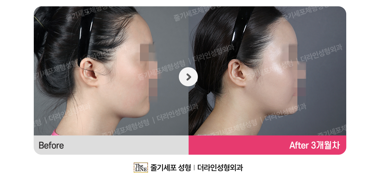 더라인성형외과 시술 상세 이미지