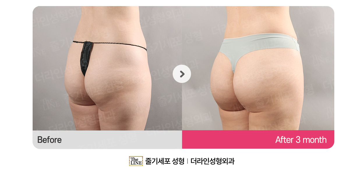 더라인성형외과 시술 상세 이미지