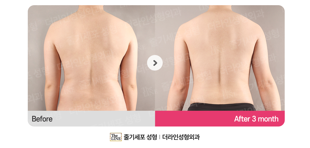 더라인성형외과 시술 상세 이미지