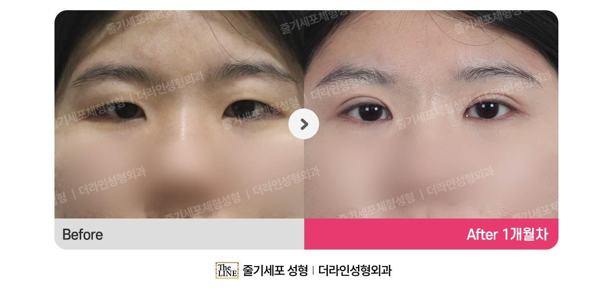 더라인성형외과 시술 상세 이미지