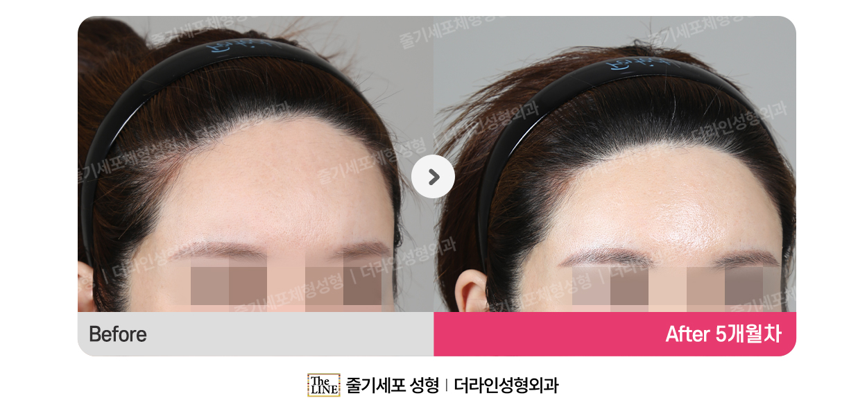 더라인성형외과 시술 상세 이미지