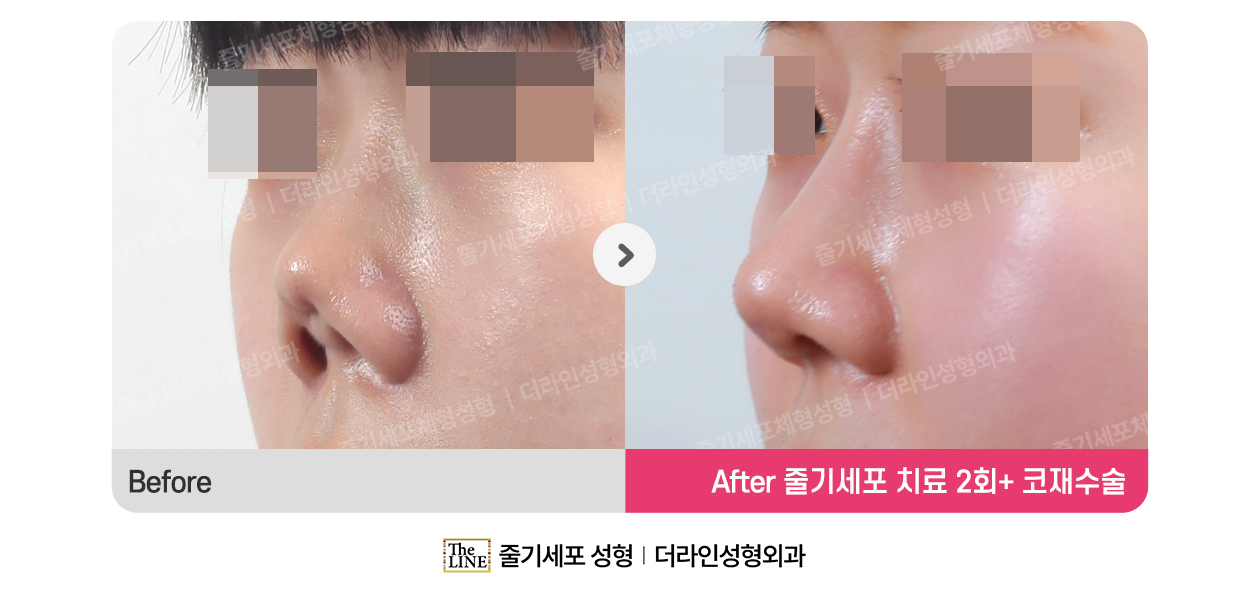 더라인성형외과 시술 상세 이미지
