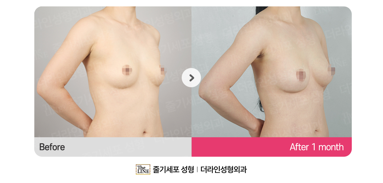 더라인성형외과 시술 상세 이미지