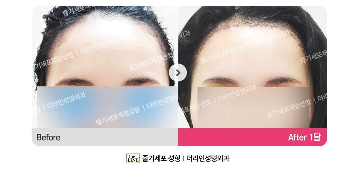 더라인성형외과 시술 상세 이미지