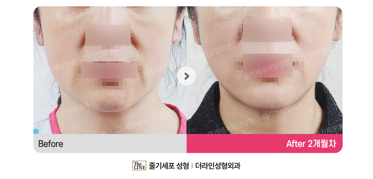 더라인성형외과 시술 상세 이미지