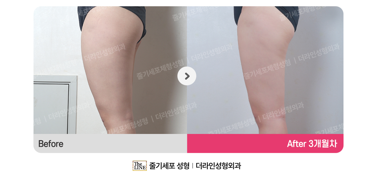 더라인성형외과 시술 상세 이미지
