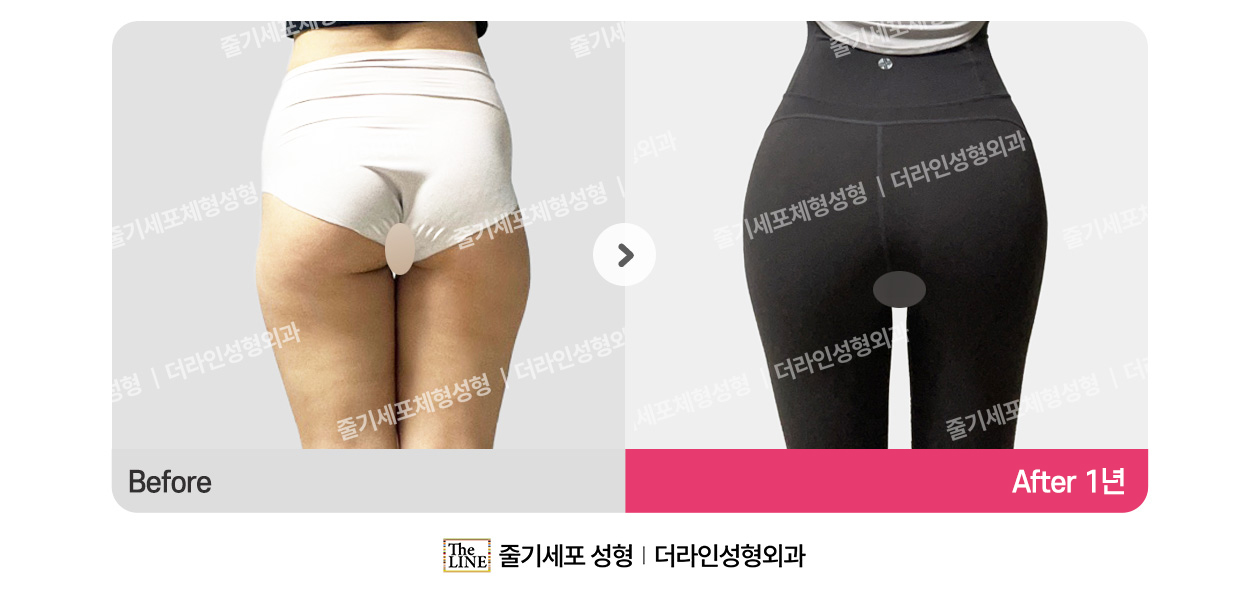 더라인성형외과 시술 상세 이미지