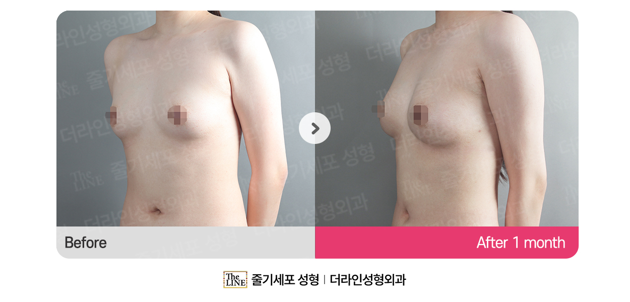 더라인성형외과 시술 상세 이미지