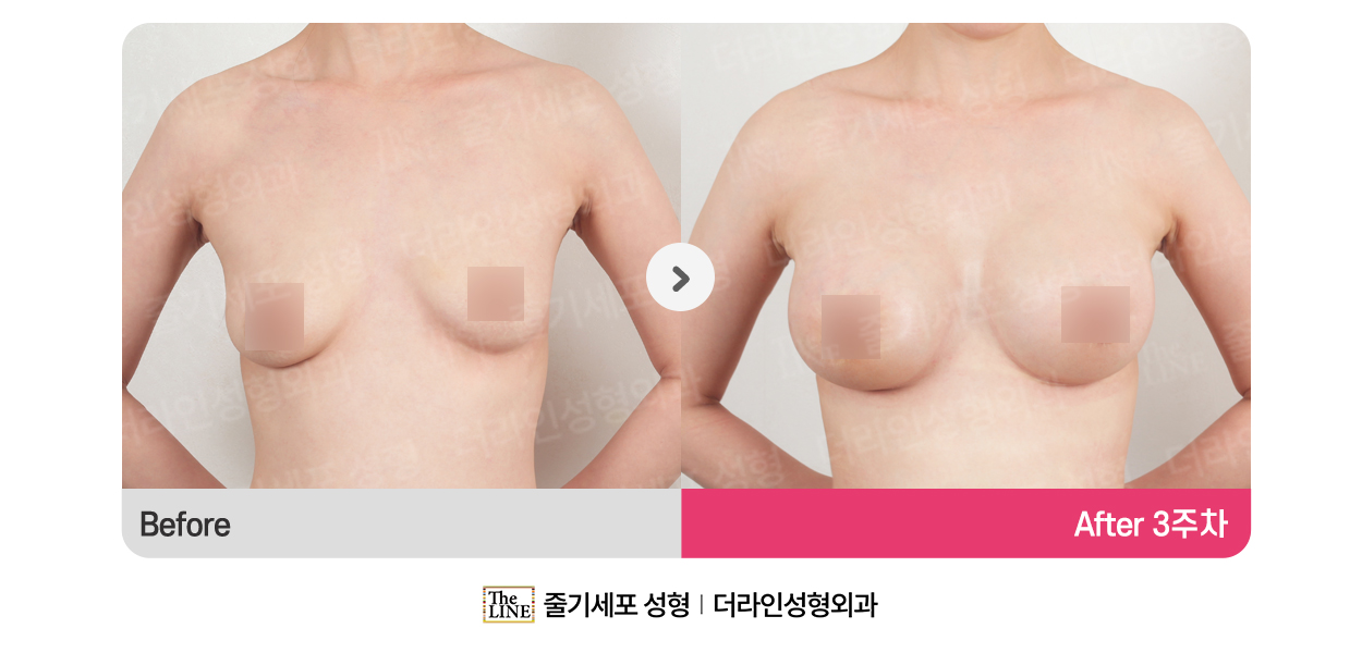 더라인성형외과 시술 상세 이미지