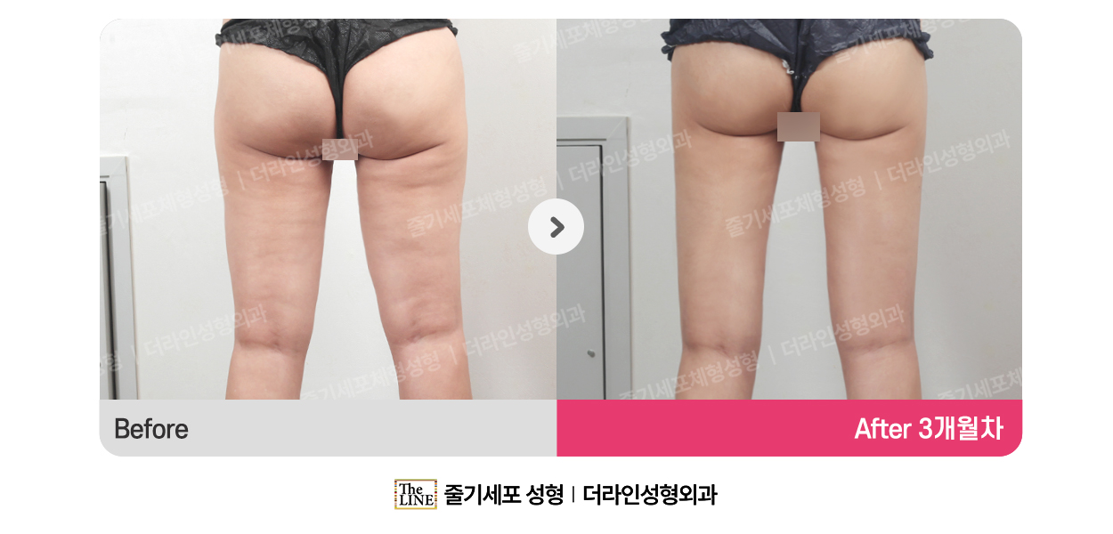 더라인성형외과 시술 상세 이미지