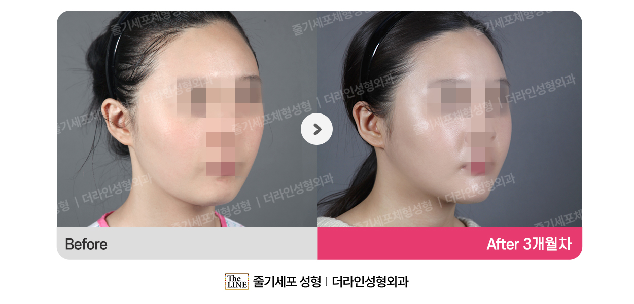 더라인성형외과 시술 상세 이미지
