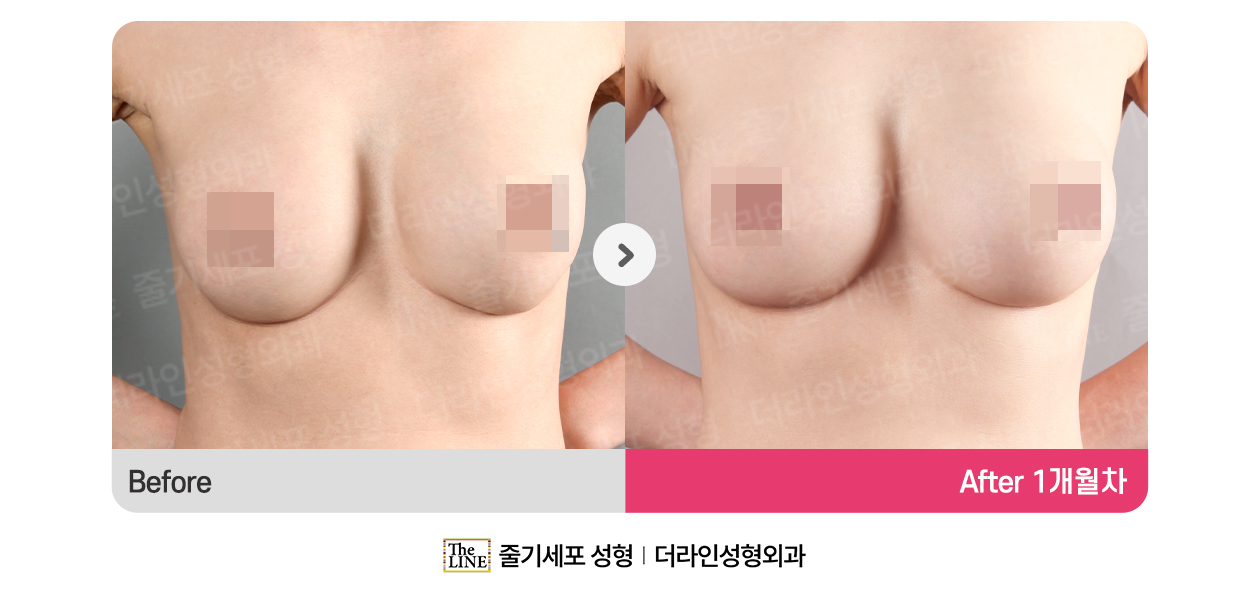 가슴성형 (통합) 대표 이미지