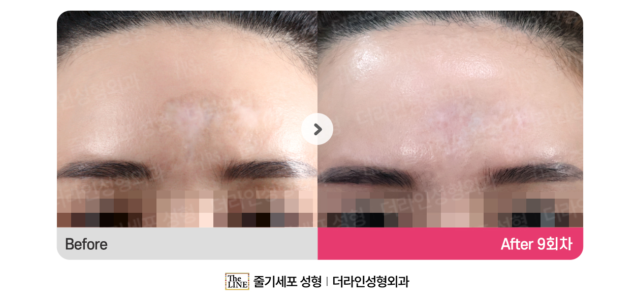 더라인성형외과 시술 상세 이미지