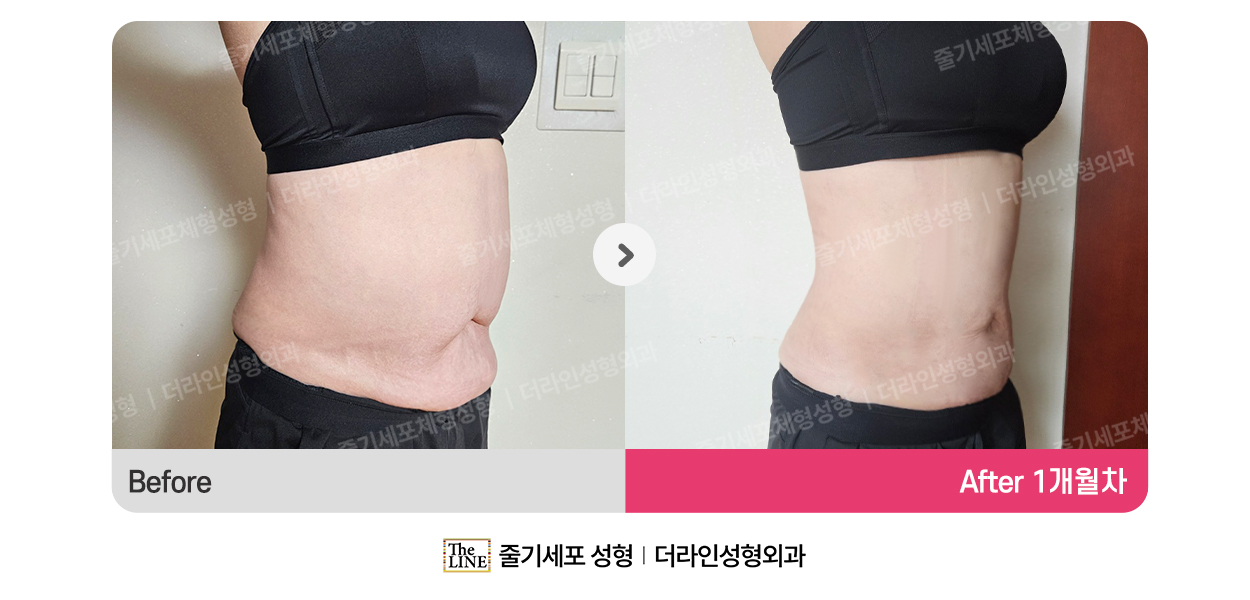 더라인성형외과 시술 상세 이미지
