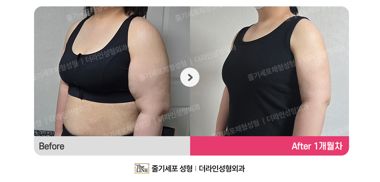 더라인성형외과 시술 상세 이미지