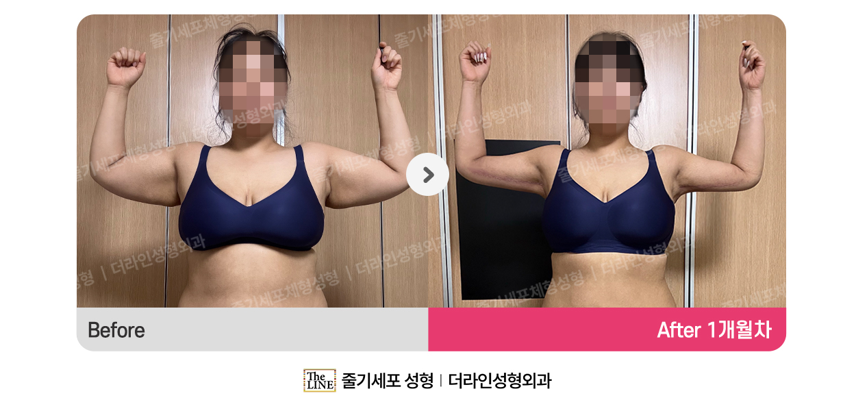 더라인성형외과 시술 상세 이미지