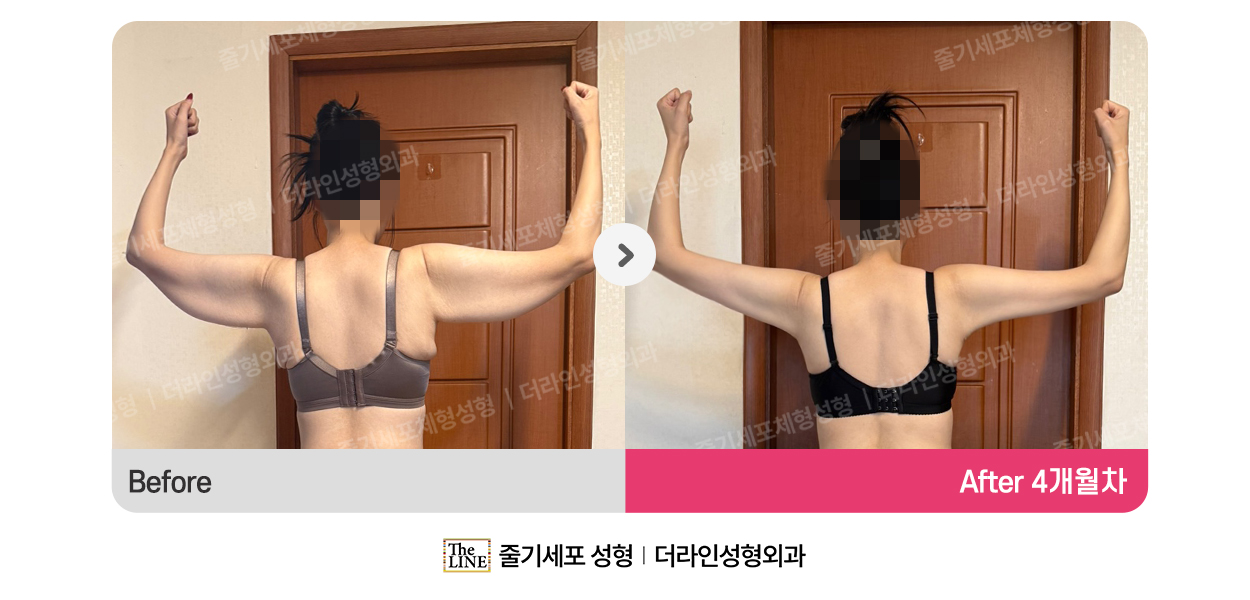 더라인성형외과 시술 상세 이미지