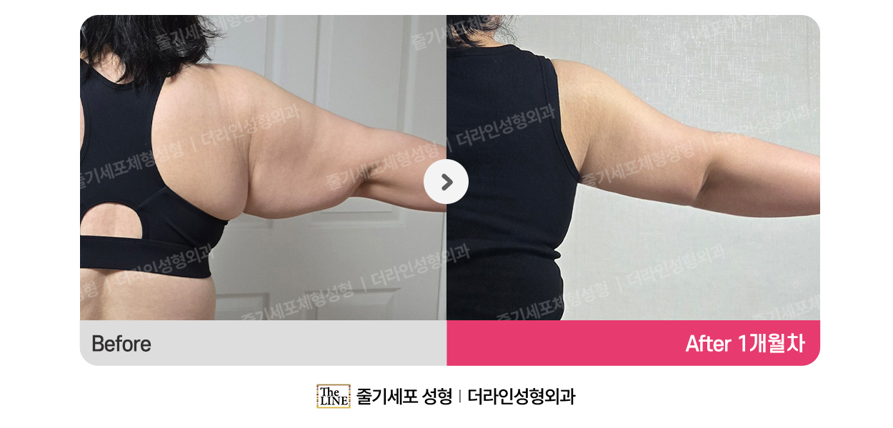 더라인성형외과 시술 상세 이미지