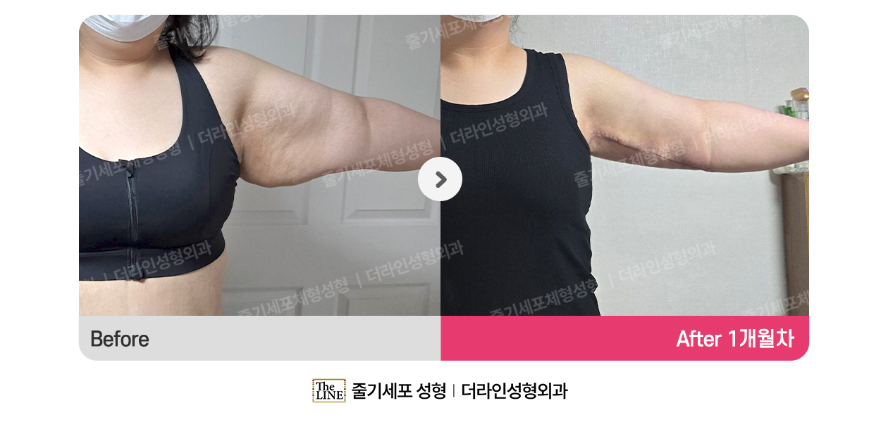 더라인성형외과 시술 상세 이미지