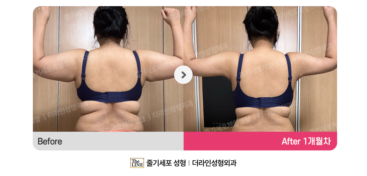 더라인성형외과 시술 상세 이미지