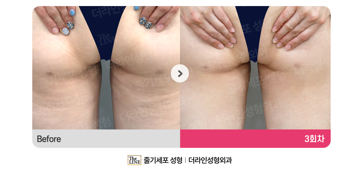 더라인성형외과 시술 상세 이미지