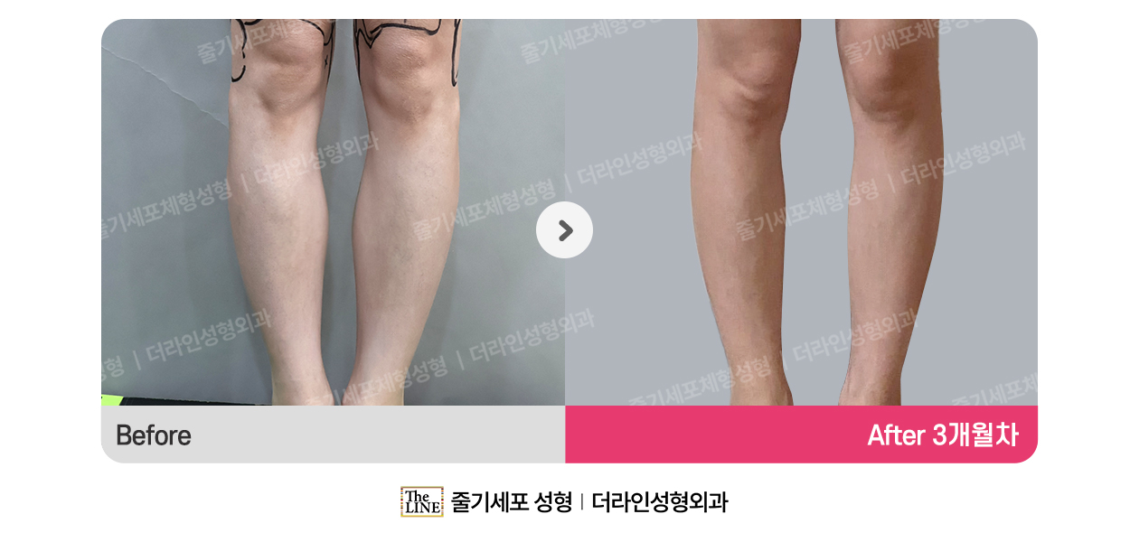더라인성형외과 시술 상세 이미지