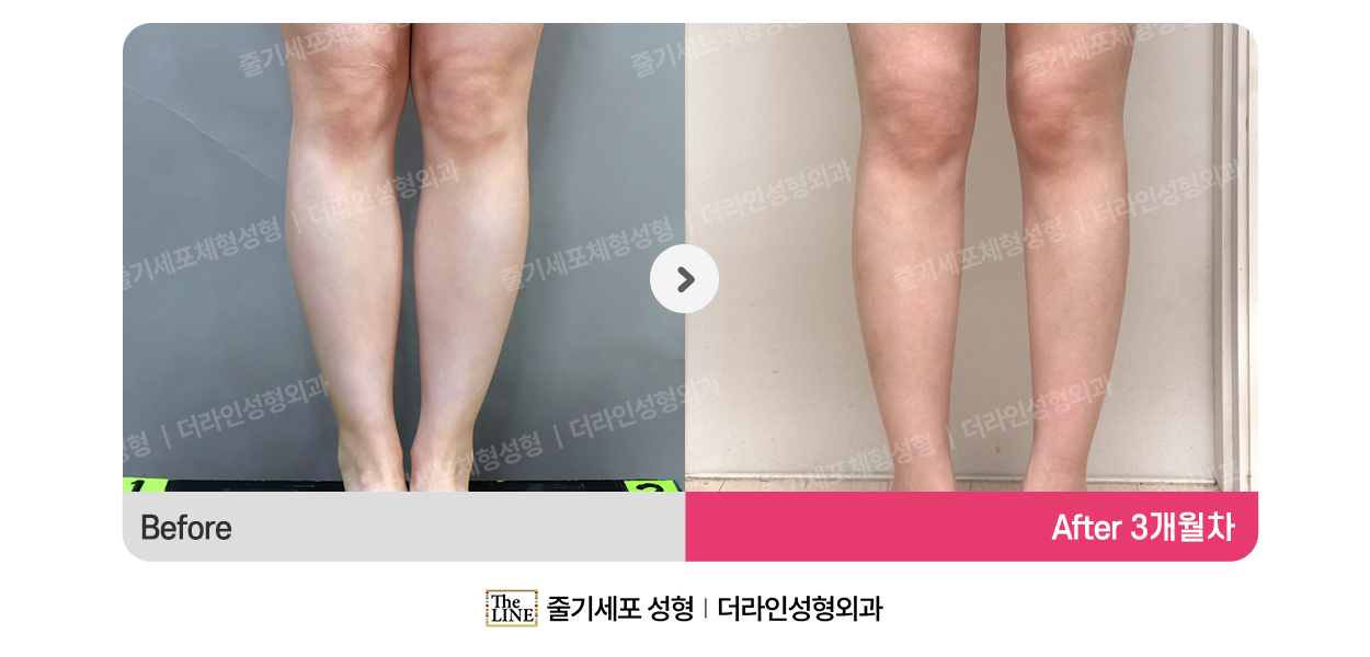 더라인성형외과 시술 상세 이미지