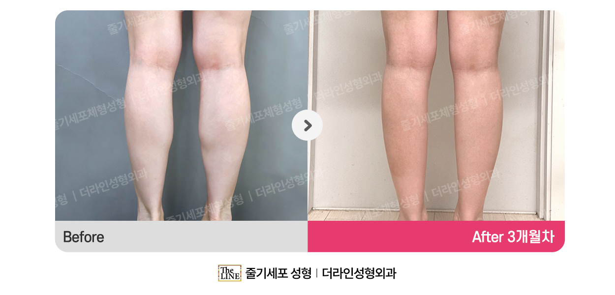 더라인성형외과 시술 상세 이미지