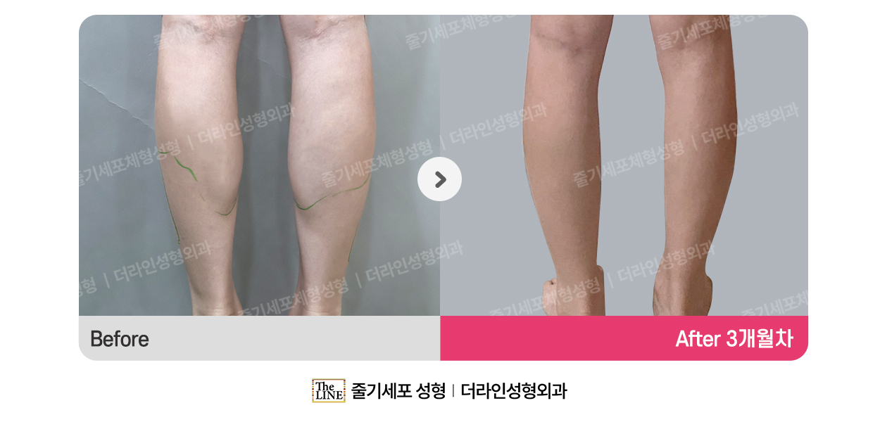 더라인성형외과 시술 상세 이미지