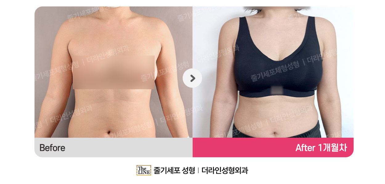 더라인성형외과 시술 상세 이미지