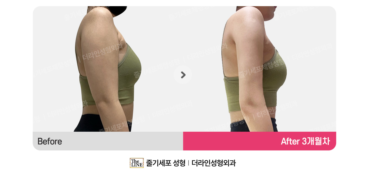 더라인성형외과 시술 상세 이미지