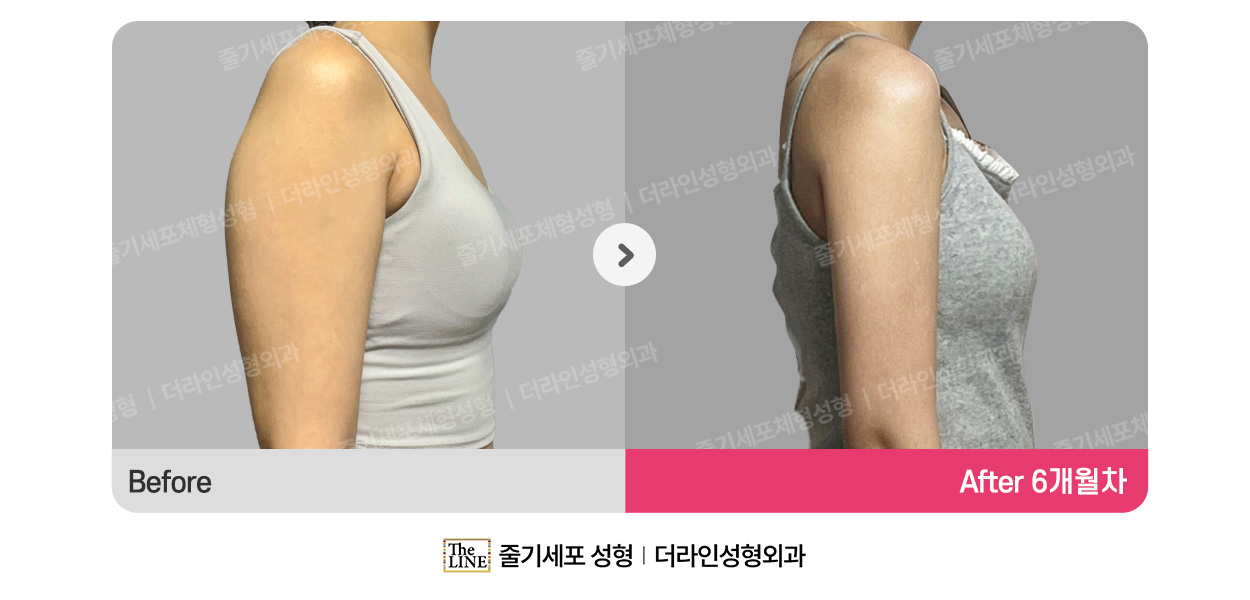 더라인성형외과 시술 상세 이미지