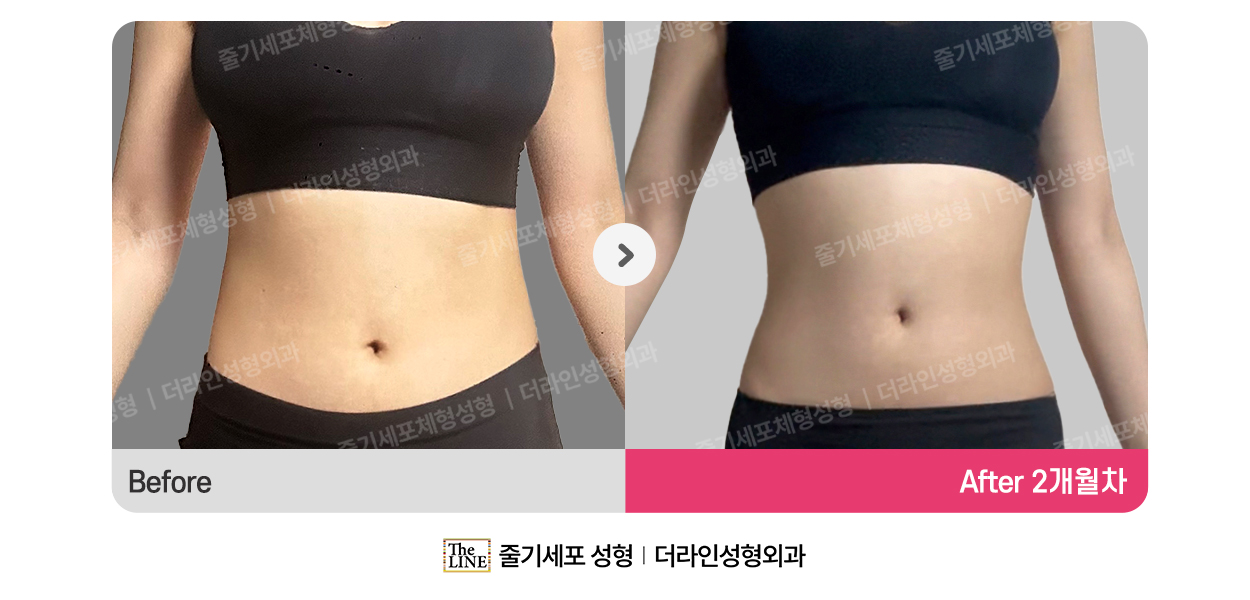 쁘띠 & 리프팅 (퀵체형·원데이) 대표 이미지