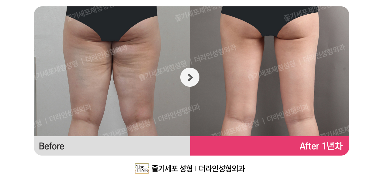 더라인성형외과 시술 상세 이미지