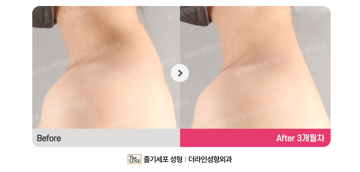 더라인성형외과 시술 상세 이미지
