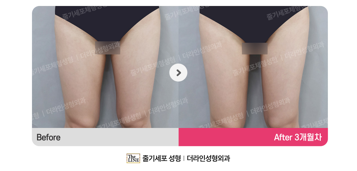 더라인성형외과 시술 상세 이미지