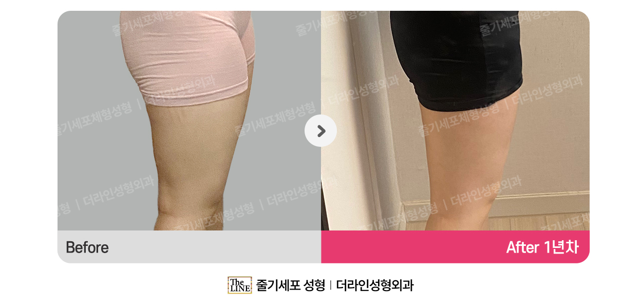 더라인성형외과 시술 상세 이미지